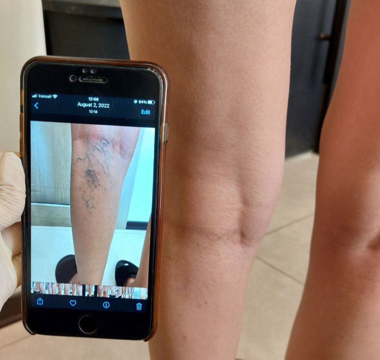 Satisfaction with Leg Varicose Vein Treatment: A Patient from Istanbul